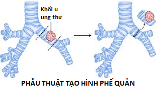 Phần 1 - Các phương án điều trị Ung thư Phổi không tế bào nhỏ theo từng giai đoạn bệnh 5 Lung cancer 1 sleeve resection